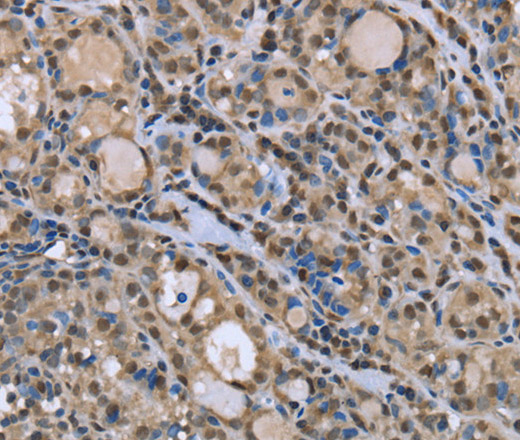 Immunohistochemistry of paraffin-embedded Human thyroid cancer tissue using DYNLL1 Polyclonal Antibody at dilution 1:30