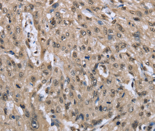 Immunohistochemistry of paraffin-embedded Human esophagus cancer tissue using DYNLL1 Polyclonal Antibody at dilution 1:30