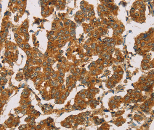 Immunohistochemistry of paraffin-embedded Human breast cancer tissue using DLL4 Polyclonal Antibody at dilution 1:50