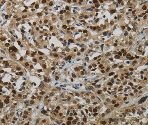 Immunohistochemistry of paraffin-embedded Human esophagus cancer tissue using DNA Ligase1 Polyclonal Antibody at dilution 1:70