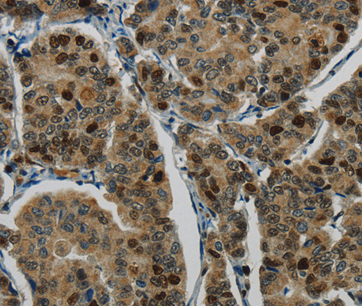 Immunohistochemistry of paraffin-embedded Human breast cancer tissue using DNA Ligase1 Polyclonal Antibody at dilution 1:70