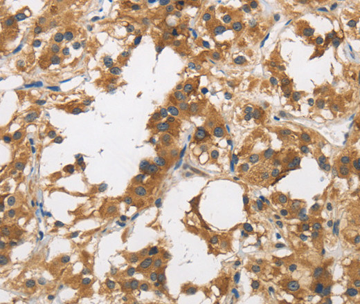 Immunohistochemistry of paraffin-embedded Human thyroid cancer tissue using DUSP23 Polyclonal Antibody at dilution 1:30