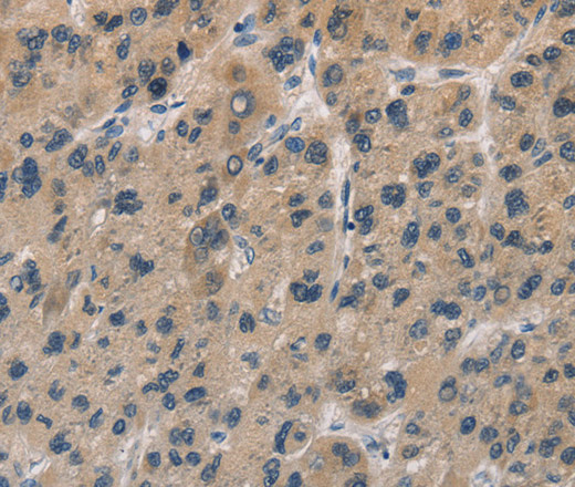 Immunohistochemistry of paraffin-embedded Human liver cancer tissue using DUSP26 Polyclonal Antibody at dilution 1:50