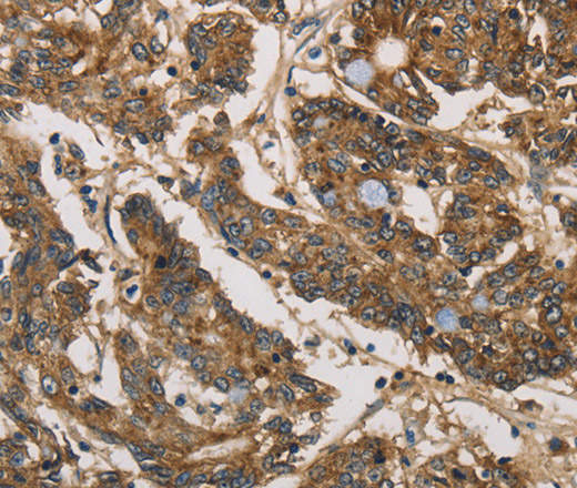 Immunohistochemistry of paraffin-embedded Human colon cancer tissue using UBE2S Polyclonal Antibody at dilution 1:40