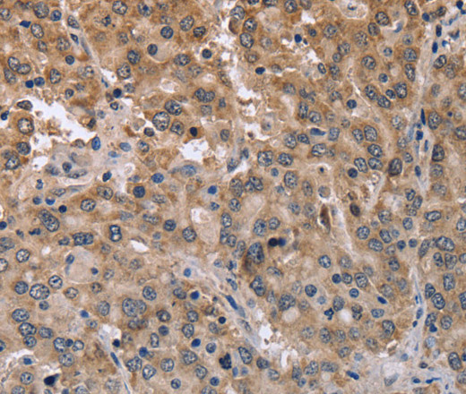 Immunohistochemistry of paraffin-embedded Human liver cancer using MAPRE3 Polyclonal Antibody at dilution of 1:50