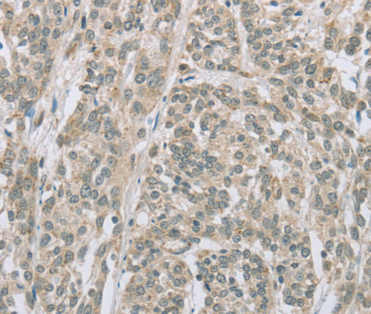 Immunohistochemistry of paraffin-embedded Human esophagus cancer using EDA2R Polyclonal Antibody at dilution of 1:50