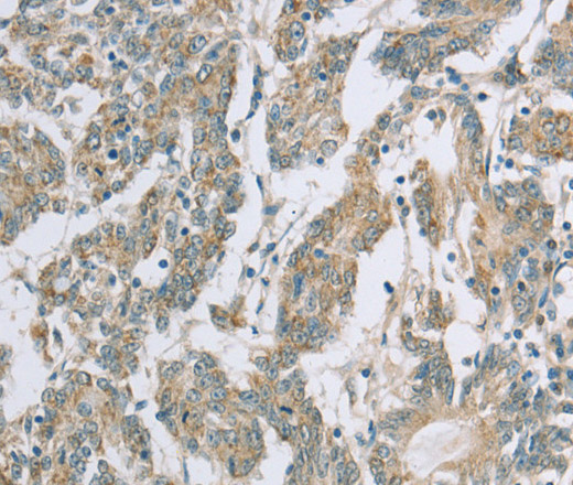 Immunohistochemistry of paraffin-embedded Human colon cancer using EDA2R Polyclonal Antibody at dilution of 1:50