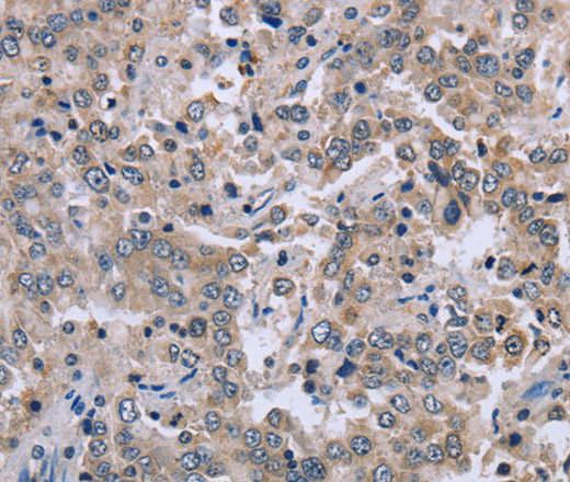 Immunohistochemistry of paraffin-embedded Human liver cancer tissue using EID1 Polyclonal Antibody at dilution 1:40