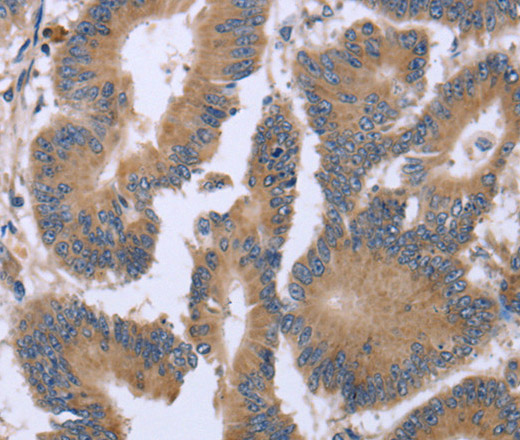 Immunohistochemistry of paraffin-embedded Human colon cancer tissue using KIAA1324 Polyclonal Antibody at dilution 1:30