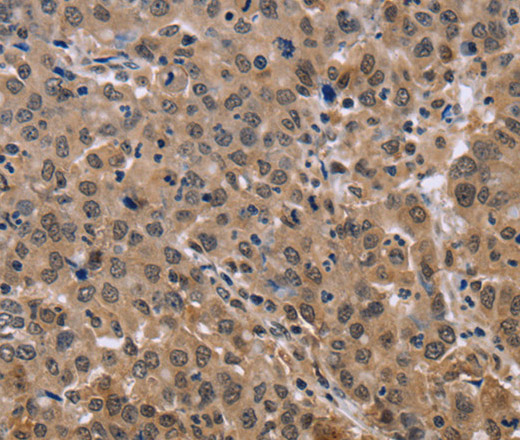 Immunohistochemistry of paraffin-embedded Human liver cancer tissue using KIF25 Polyclonal Antibody at dilution 1:40