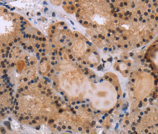 Immunohistochemistry of paraffin-embedded Human thyroid cancer tissue using KIF25 Polyclonal Antibody at dilution 1:40