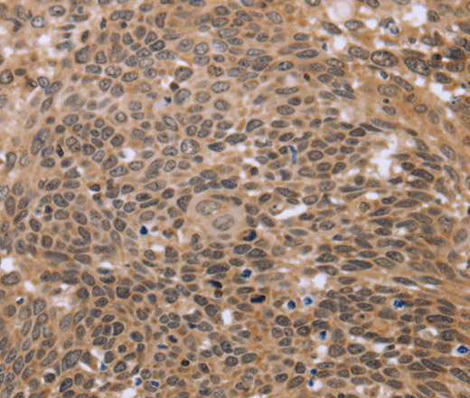 Immunohistochemistry of paraffin-embedded Human cervical cancer tissue using ERCC6L Polyclonal Antibody at dilution 1:30