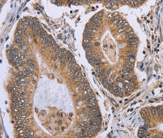 Immunohistochemistry of paraffin-embedded Human colon cancer tissue using ERCC6L Polyclonal Antibody at dilution 1:30