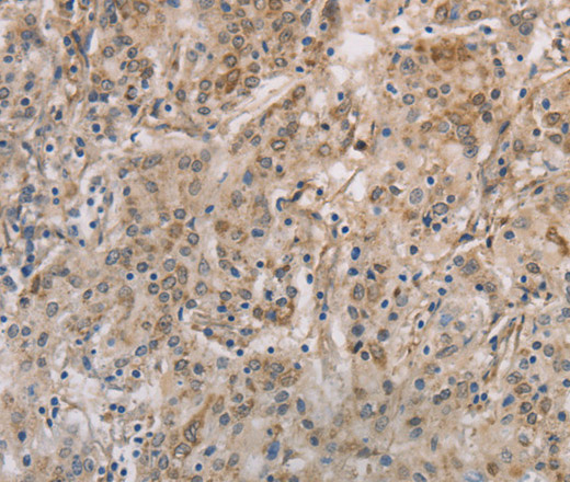 Immunohistochemistry of paraffin-embedded Human gastic cancer using ESRRG Polyclonal Antibody at dilution of 1:30