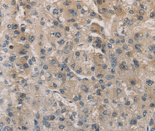 Immunohistochemistry of paraffin-embedded Human liver cancer using ESRRG Polyclonal Antibody at dilution of 1:30