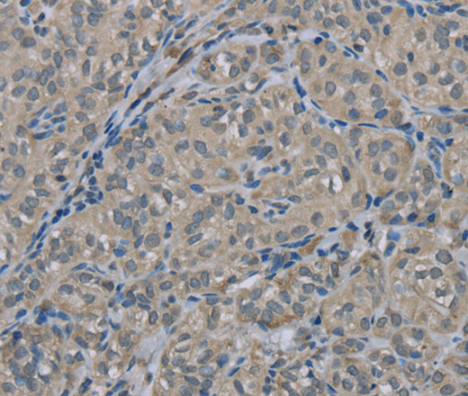 Immunohistochemistry of paraffin-embedded Human thyroid cancer tissue using EDN1 Polyclonal Antibody at dilution 1:30