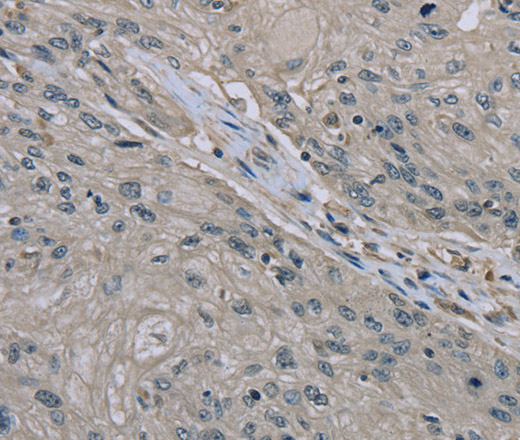 Immunohistochemistry of paraffin-embedded Human esophagus cancer tissue using EDN1 Polyclonal Antibody at dilution 1:30