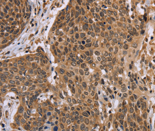 Immunohistochemistry of paraffin-embedded Human cervical cancer tissue using EDN2 Polyclonal Antibody at dilution 1:30