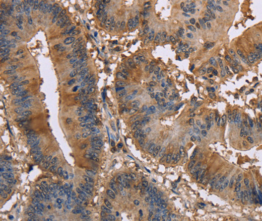 Immunohistochemistry of paraffin-embedded Human colon cancer tissue using EDN2 Polyclonal Antibody at dilution 1:30