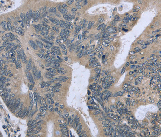 Immunohistochemistry of paraffin-embedded Human colon cancer tissue using BMX Polyclonal Antibody at dilution 1:30