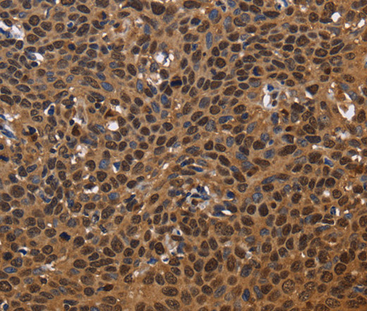 Immunohistochemistry of paraffin-embedded Human cervical cancer tissue using EXTL3 Polyclonal Antibody at dilution 1:50