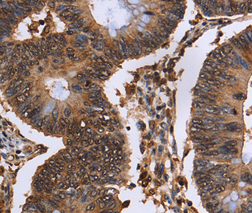 Immunohistochemistry of paraffin-embedded Human colon cancer tissue using EXTL3 Polyclonal Antibody at dilution 1:50