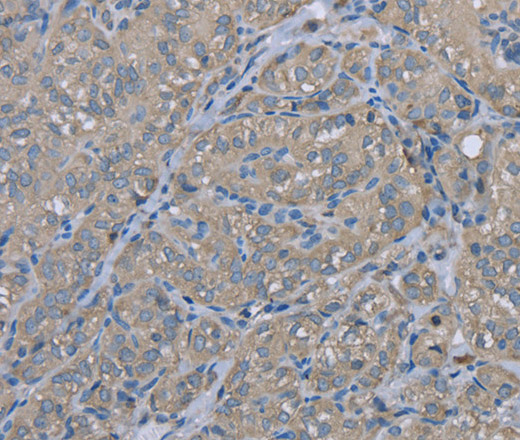 Immunohistochemistry of paraffin-embedded Human thyroid cancer using EZR Polyclonal Antibody at dilution of 1:30