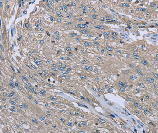 Immunohistochemistry of paraffin-embedded Human esophagus cancer using EZR Polyclonal Antibody at dilution of 1:30