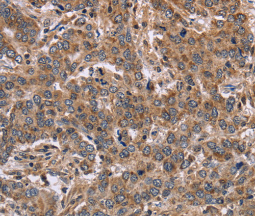 Immunohistochemistry of paraffin-embedded Human liver cancer tissue using FAAH2 Polyclonal Antibody at dilution 1:30