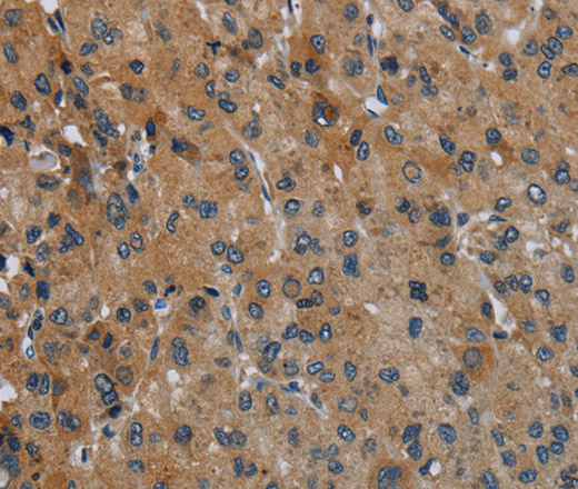 Immunohistochemistry of paraffin-embedded Human liver cancer using FAAH Polyclonal Antibody at dilution of 1:50