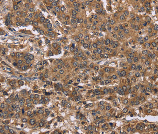 Immunohistochemistry of paraffin-embedded Human liver cancer tissue using FABP6 Polyclonal Antibody at dilution 1:30