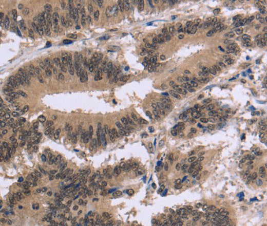 Immunohistochemistry of paraffin-embedded Human colon cancer tissue using FAM107A Polyclonal Antibody at dilution 1:30