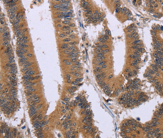 Immunohistochemistry of paraffin-embedded Human colon cancer tissue using FAM3B Polyclonal Antibody at dilution 1:30