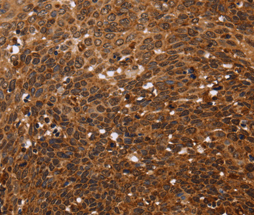 Immunohistochemistry of paraffin-embedded Human cervical cancer tissue using FANCF Polyclonal Antibody at dilution 1:60