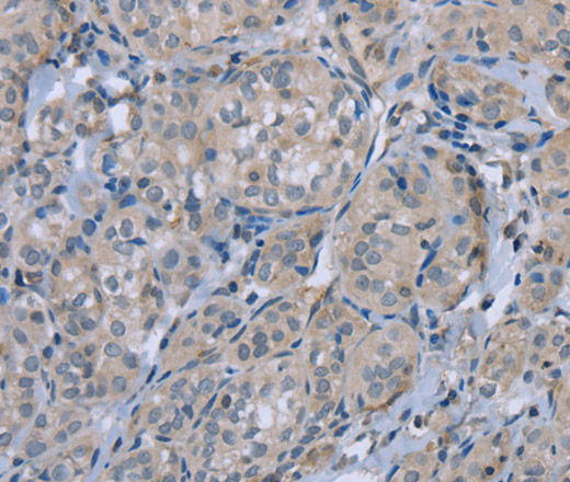 Immunohistochemistry of paraffin-embedded Human thyroid cancer tissue using FAP Polyclonal Antibody at dilution 1:30