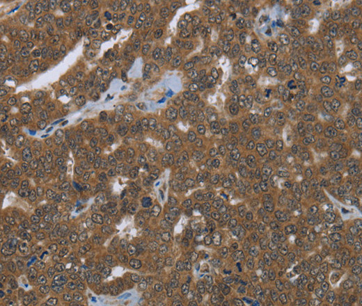 Immunohistochemistry of paraffin-embedded Human ovarian cancer tissue using FASTKD1 Polyclonal Antibody at dilution 1:50