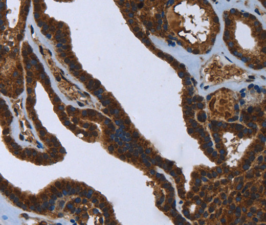 Immunohistochemistry of paraffin-embedded Human thyroid cancer using FASTKD2 Polyclonal Antibody at dilution of 1:45