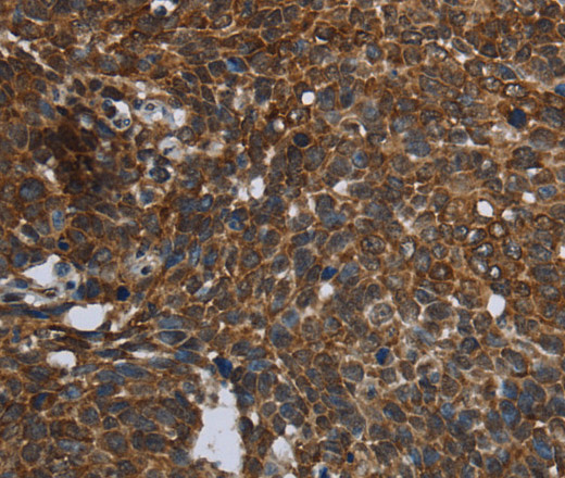 Immunohistochemistry of paraffin-embedded Human cervical cancer using FASTKD2 Polyclonal Antibody at dilution of 1:45