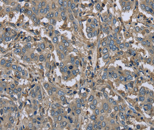 Immunohistochemistry of paraffin-embedded Human liver cancer using FBP1 Polyclonal Antibody at dilution of 1:30