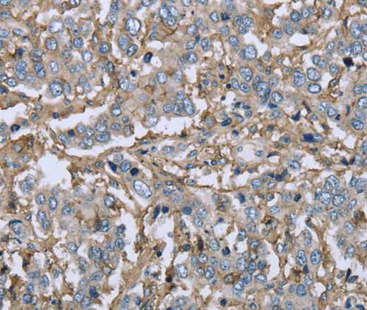 Immunohistochemistry of paraffin-embedded Human liver cancer using CD32 Polyclonal Antibody at dilution of 1:40