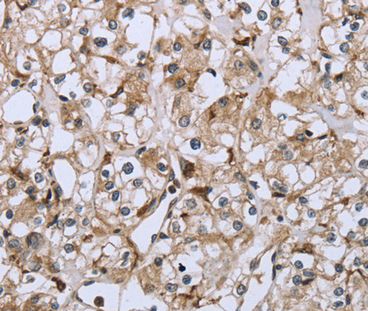 Immunohistochemistry of paraffin-embedded Human prostate cancer using CD32 Polyclonal Antibody at dilution of 1:40