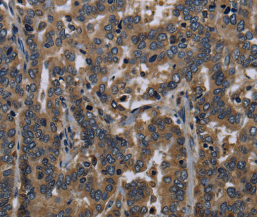 Immunohistochemistry of paraffin-embedded Human liver cancer tissue using FGF18 Polyclonal Antibody at dilution 1:40