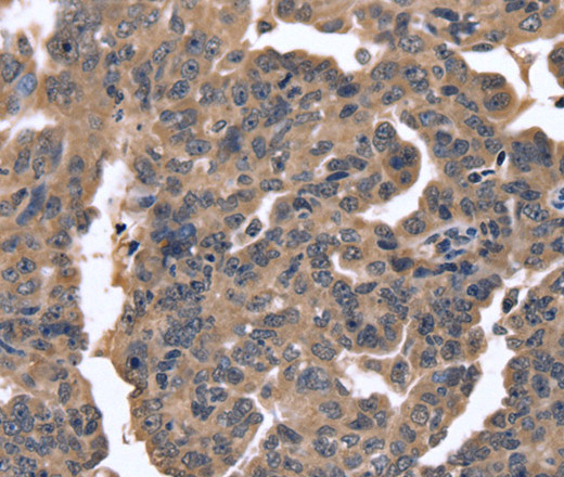 Immunohistochemistry of paraffin-embedded Human ovarian cancer tissue using FGFR1OP2 Polyclonal Antibody at dilution 1:40