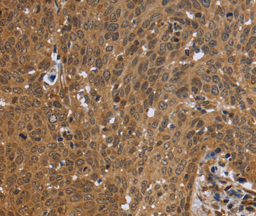 Immunohistochemistry of paraffin-embedded Human cervical cancer using FHL2 Polyclonal Antibody at dilution of 1:50