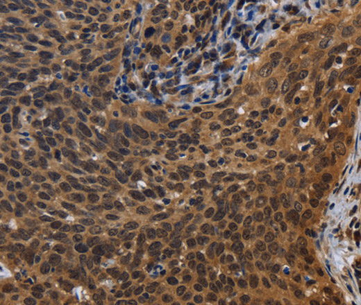 Immunohistochemistry of paraffin-embedded Human cervical cancer tissue using FHL3 Polyclonal Antibody at dilution 1:40