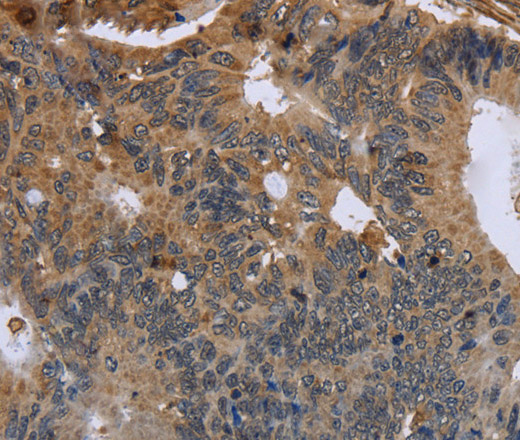 Immunohistochemistry of paraffin-embedded Human colon cancer using FLNA Polyclonal Antibody at dilution of 1:50