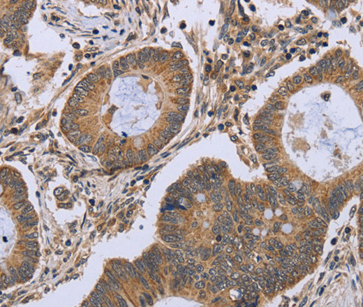 Immunohistochemistry of paraffin-embedded Human colon cancer using FKBP8 Polyclonal Antibody at dilution of 1:50