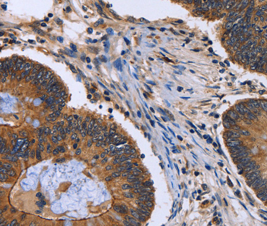 Immunohistochemistry of paraffin-embedded Human colon cancer using FRK Polyclonal Antibody at dilution of 1:40