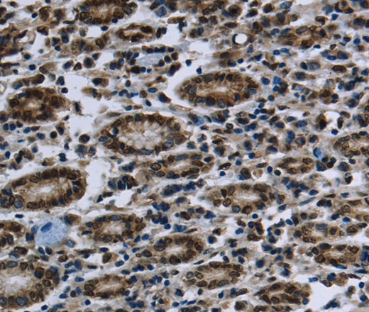 Immunohistochemistry of paraffin-embedded Human gastic cancer using FTO Polyclonal Antibody at dilution of 1:60