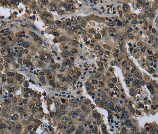 Immunohistochemistry of paraffin-embedded Human liver cancer using FTO Polyclonal Antibody at dilution of 1:60